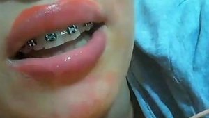 Mouth Fetish Braces Part2 Free Webcam Hd Porn 81 Xhamster